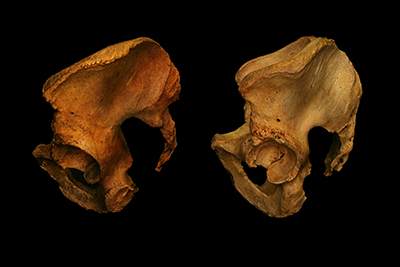 Photo of left hip socket of two pelvises