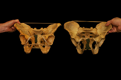 Photo of two hip sockets pointing in different directions