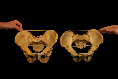 Photo of two hip sockets